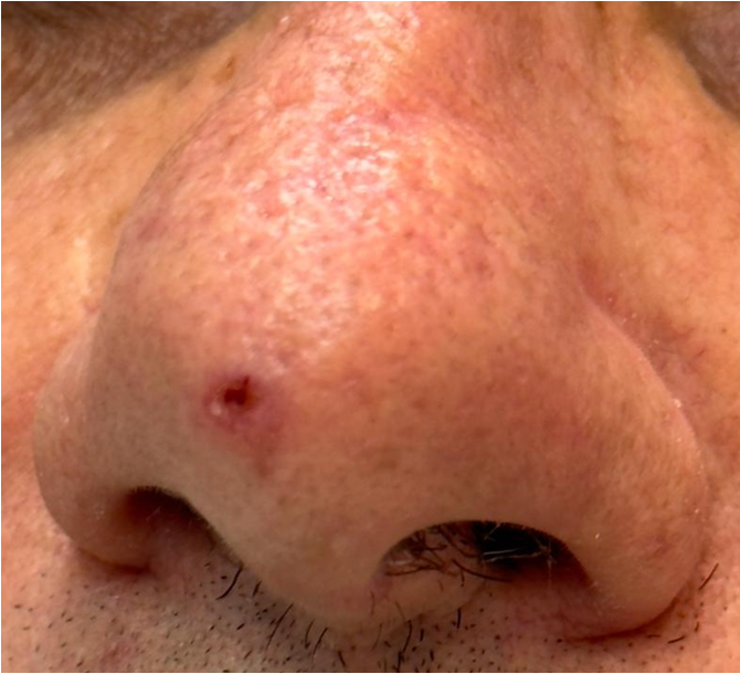 Carcinoma Basocelular na ponta do nariz — lesão escurecida com bordas definidas