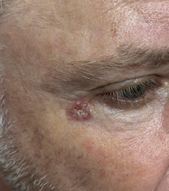 Carcinoma Basocelular próximo ao canto do olho — lesão avermelhada com crosta