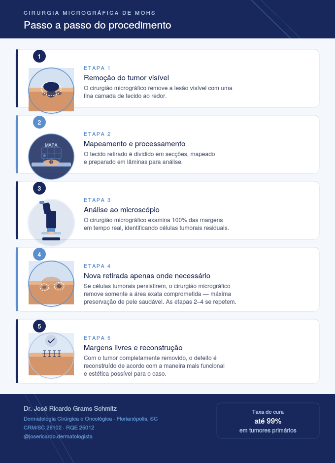 Infográfico das etapas da Cirurgia Micrográfica de Mohs: remoção, análise, confirmação e reconstrução